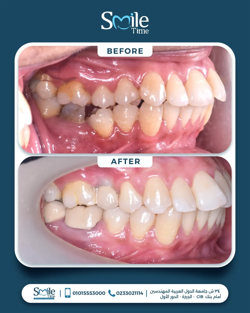 smile-time-before-and-after-2