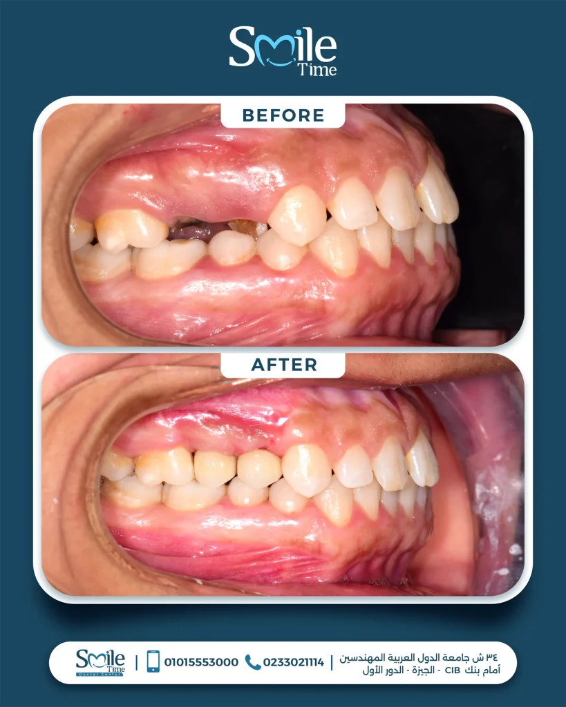 smile-time-before-and-after-3
