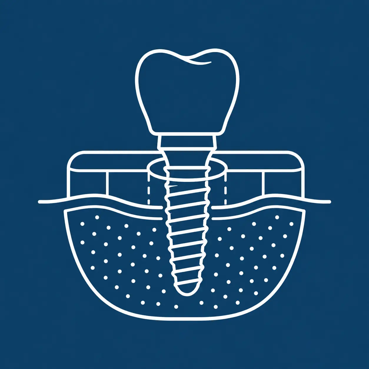 Flapless Implants icon