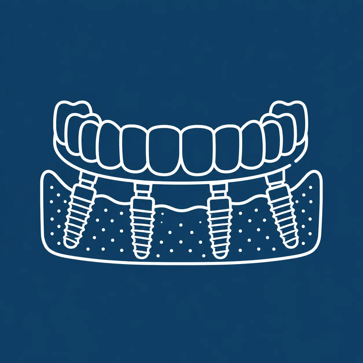Full-Arch Implants icon